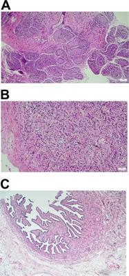 45,X[2]/46,X,der(Y).ish Psu idic(Y)(q11.2)[38] mosaic karyotype in mixed gonadal dysgenesis: a case report and literature review